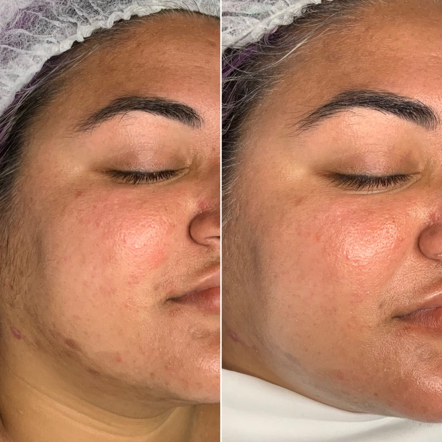 Get Radiant Skin with Microneedling: A Skincare Solution You Need to Know About