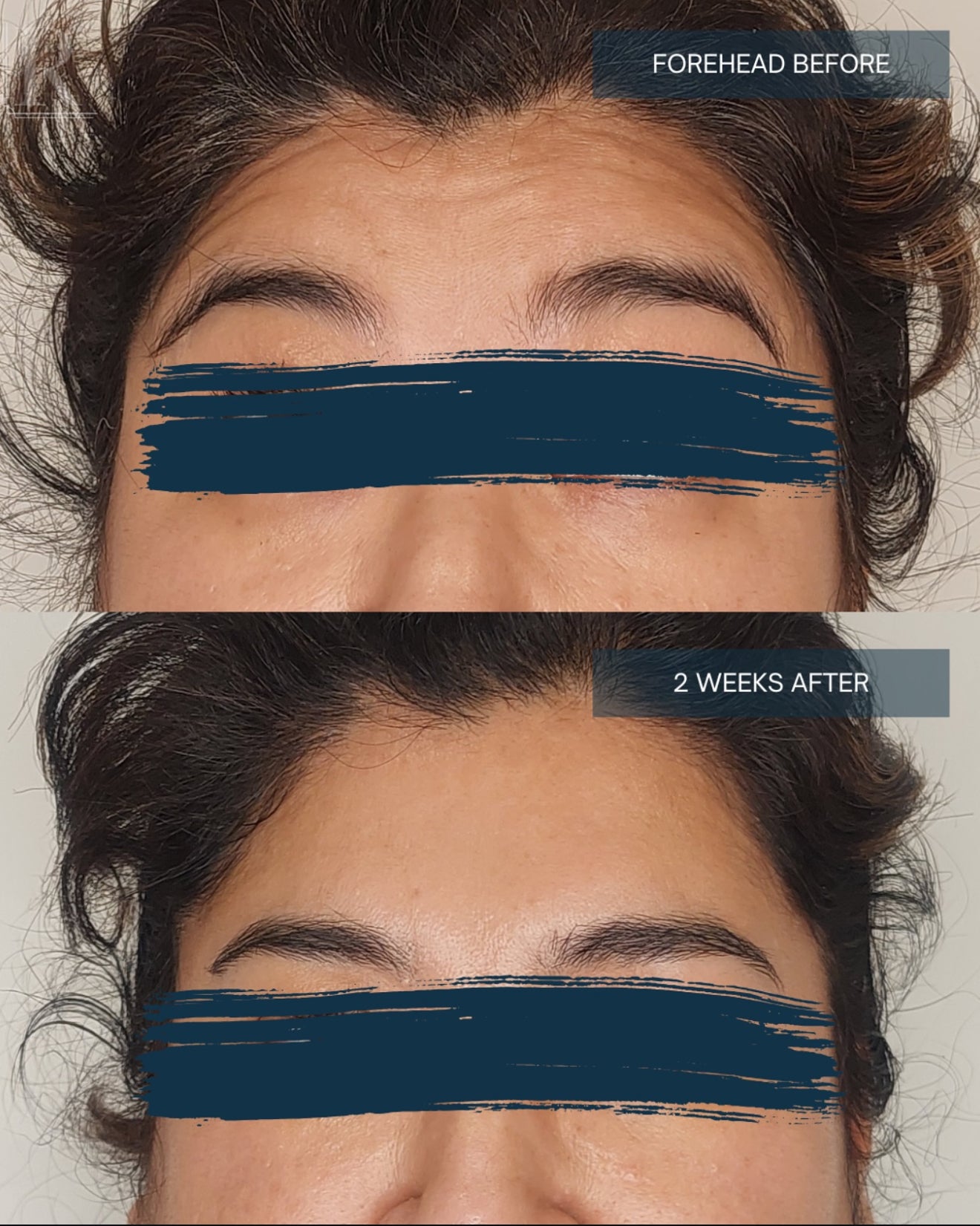 Toronto Liberty Village Botox - Dermal Fillers - Cosmetic Injections Clinic - Beauty Room Toronto Liberty Village Botox - Dermal Fillers - Cosmetic Injections Clinic - Beauty Room