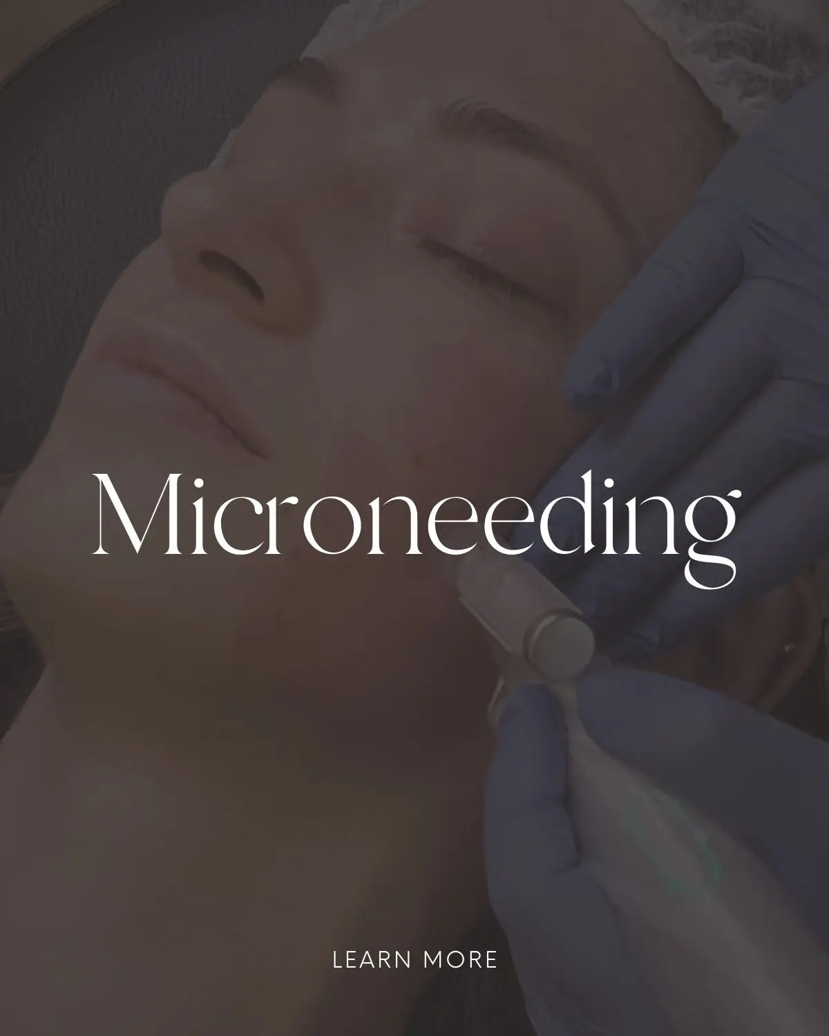 Microneedling facial treatment for skin rejuvenation in Toronto